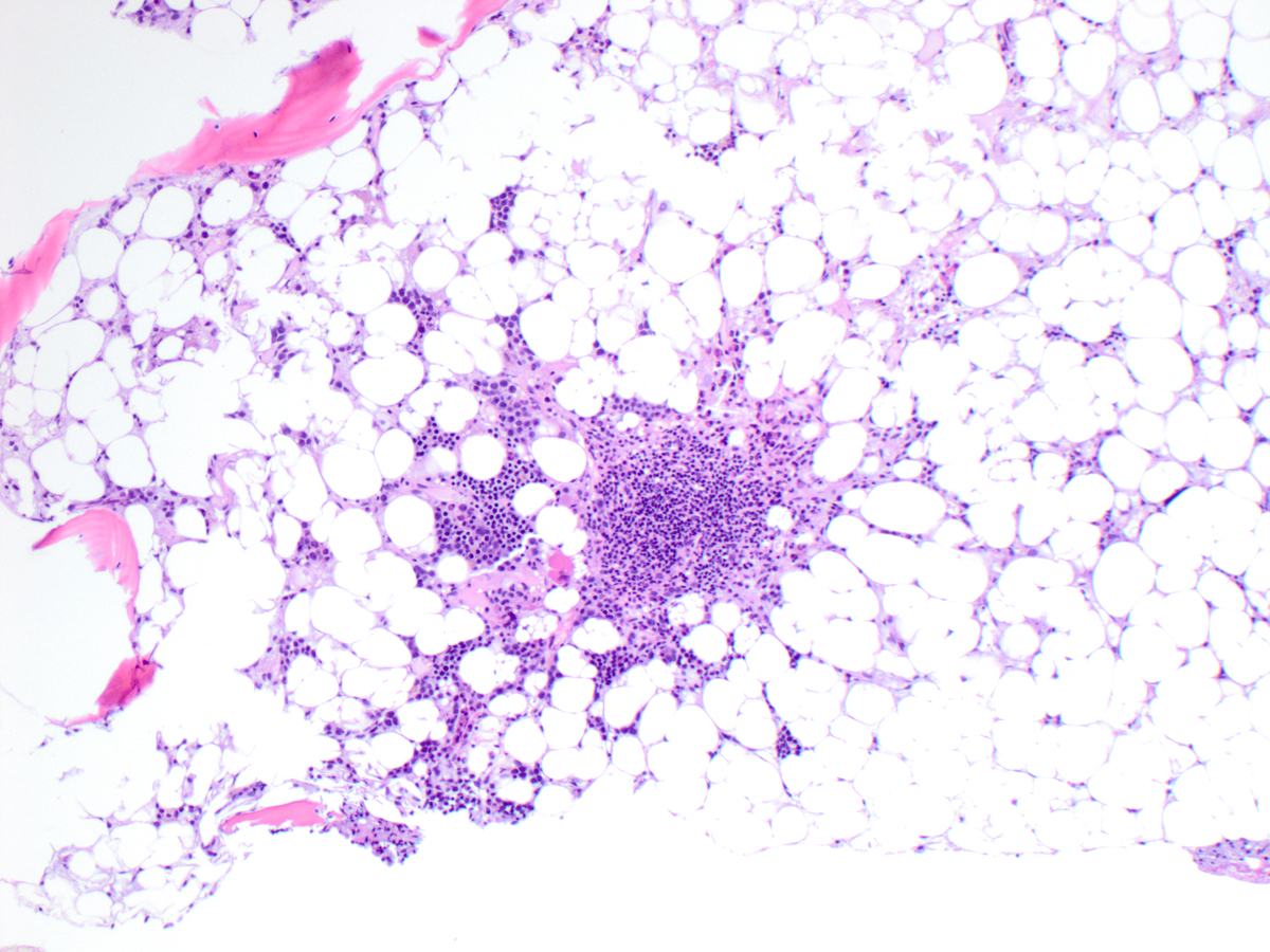 Specimen 3, BM core biopsy, H&E x 100